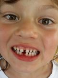 Náhled: první mléčný zub venku